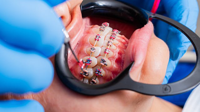 Orthodontic Care